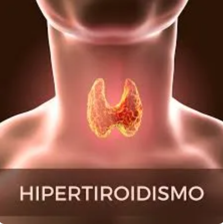 Hipertireoidismo